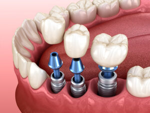 implantes dentários
